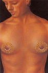 Preoperative appearance male breast reduction photo	