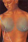 Intraoperative liposuction male breast reduction