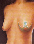 Operative markings breast lift photo