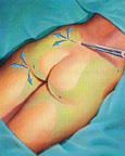 Intraoperative liposuction liposuction photo