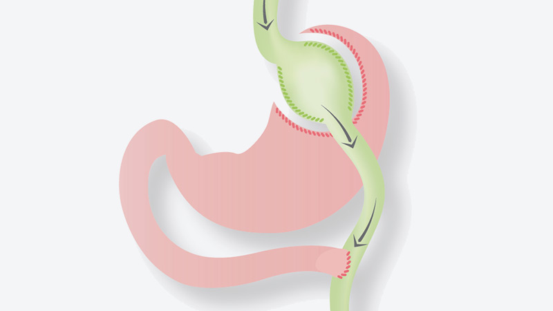 Gastric Bypass Surgery