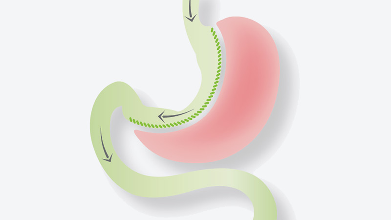 Sleeve Gastrectomy