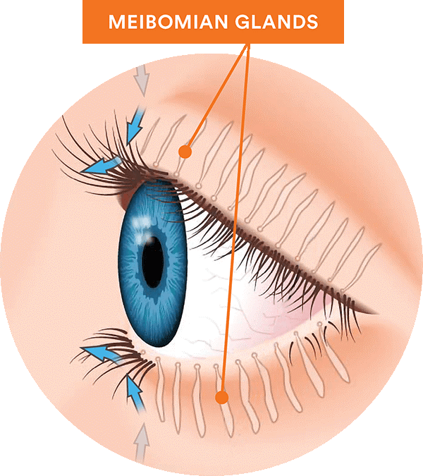 Image of a Dry Eye with Meibomian Gland Dysfunction