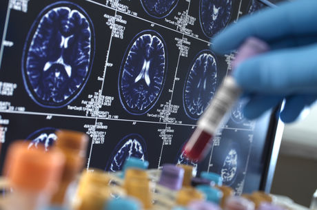 What’s on the horizon for Alzheimer’s Disease research