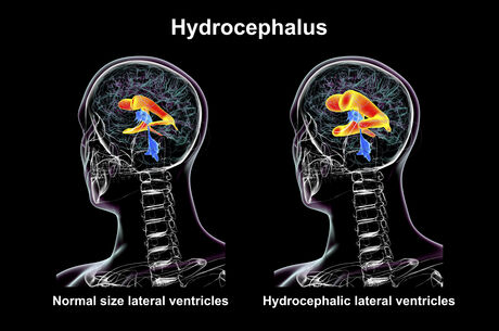 I’ve been diagnosed with Normal Pressure Hydrocephalus. Now what?
