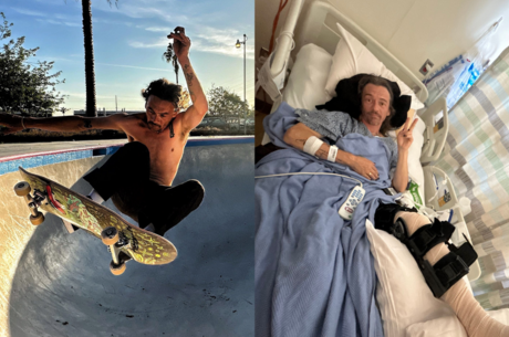 The trick that split his tibia: a skateboarder's story of recovery after a gruesome leg injury