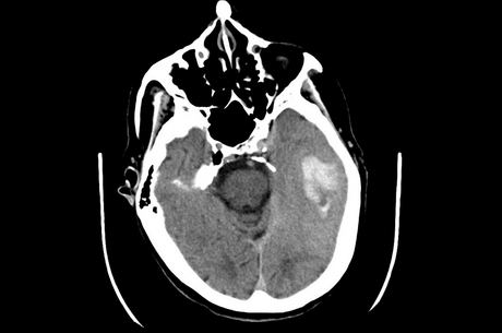 Strokes are getting younger: the alarming rise in stroke rates among young people