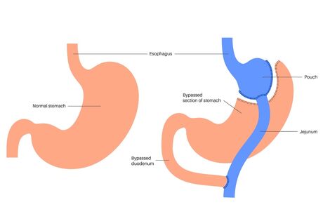 Gastric sleeve procedure: A long-term solution for weight loss