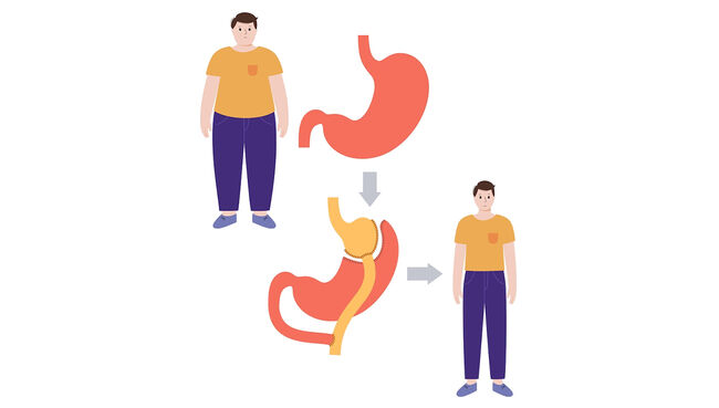 Gastric Sleeve
