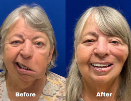 Before and after photos of caucasian woman with gray hair smiling