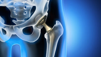 illustration of hip replacement
