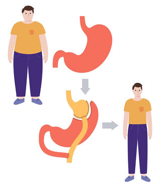 Gastric Sleeve
