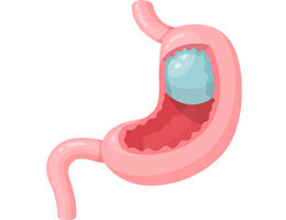 Intragastric Balloon