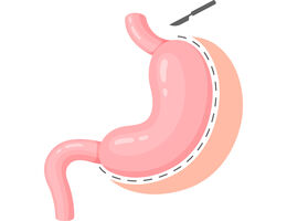 Sleeve Gastrectomy