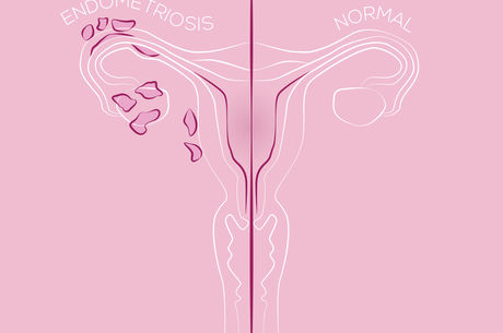 Illustration of endometriosis