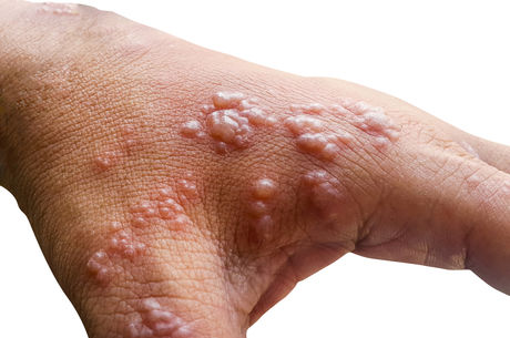 Monkeypox: Risk factors, severity and more