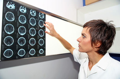 Do strokes affect women differently?