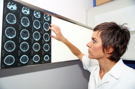 Do strokes affect women differently?