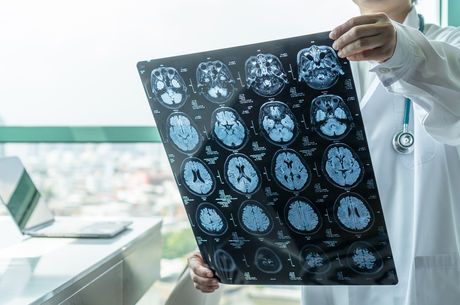 Lasting brain impacts from COVID-19 are equivalent to decades of aging