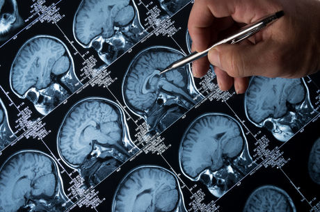 It’s not always Alzheimer’s. What is NPH and how is it different?