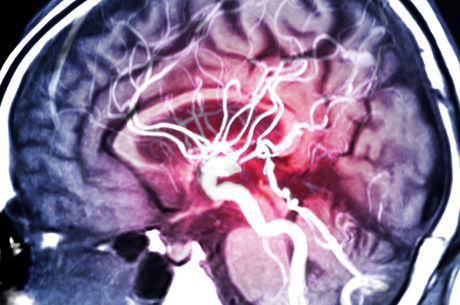 Stroke: a leading cause of death and disability in the United States