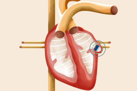 An animated depiction of the Watchman device on the heart. Photo courtesy of Boston Scientific.