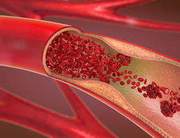 The ABC’s of coronary artery disease